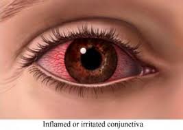 Dry Eye Syndrome and Ayurveda.