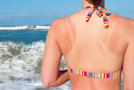 Sunburn and Ayurveda